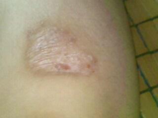 牛皮癣患者可以吹风吗