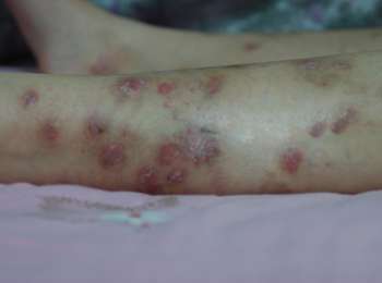 牛皮癣护理知识您了解多少