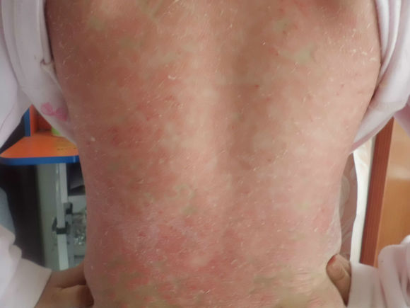 治愈牛皮癣的方法有哪些呢