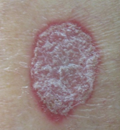 怎么能够防治牛皮癣呢