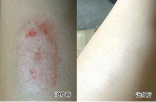 为什么牛皮癣治愈后还会复发