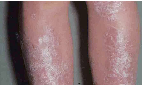 究竟要怎样可以治牛皮癣呢