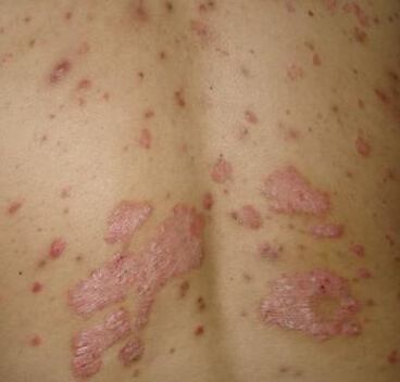 医学上治疗牛皮癣的注意事项