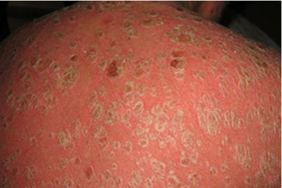 牛皮癣病人怎样补钙