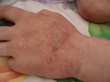 内分泌异常会诱发牛皮癣吗