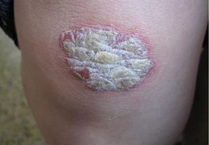 专家讲解牛皮癣诱发原因分析