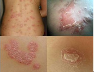 牛皮癣的主要病因有哪些