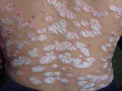 造成牛皮癣疾病不断复发的原因有哪些