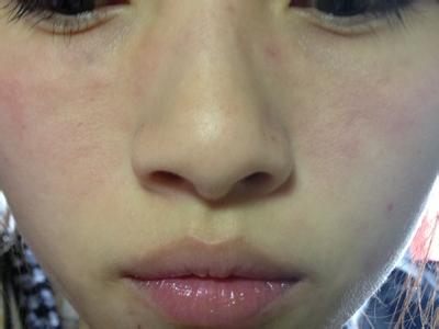 面部牛皮癣有哪些症状表现