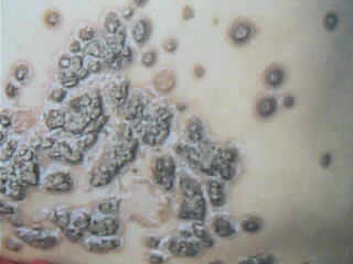 牛皮癣主要的症状表现有哪些