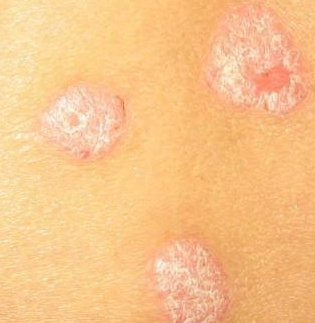 ​牛皮癣好转有哪些表现