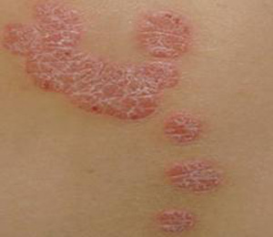 牛皮癣不同季节发病的症状的表现