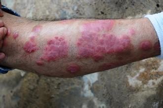 牛皮癣的危害不容小觑