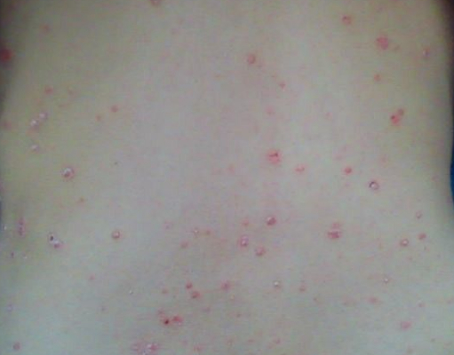 牛皮癣有哪些危害性较大的损害