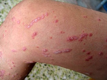 牛皮癣会遗传吗