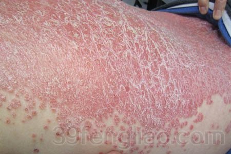 揭秘牛皮癣的危害到底有多大