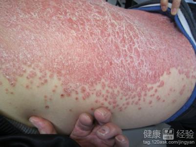 牛皮癣的危害有哪些