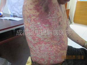 银屑病患者的四年之痒