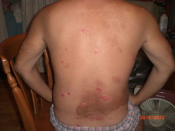 哪些治疗误区是牛皮癣患者应该避免的