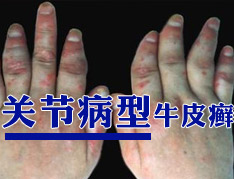 关节型牛皮癣该怎么治疗
