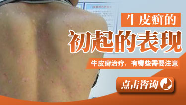 牛皮癣都有哪些症状