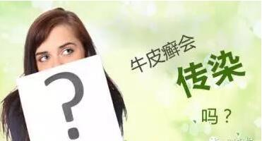 牛皮癣会不会传染给别人