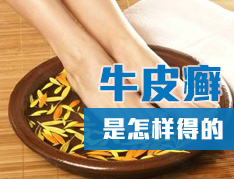 什么情况下容易得牛皮癣疾病