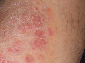 牛皮癣对洗桑拿浴有没有好处