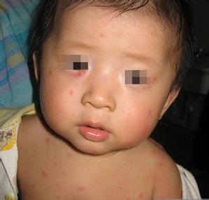 脸部牛皮癣的护理