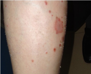 脸部牛皮癣的症状有什么