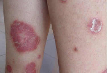 你知道牛皮癣的症状有哪些