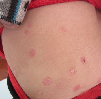 牛皮癣的病因是什么引起的