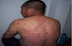 牛皮癣的预防措施有哪些