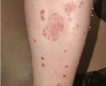 牛皮癣在发病时的症状有哪些