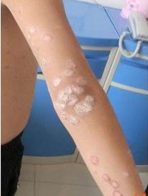 牛皮癣患者的护理常识有哪些