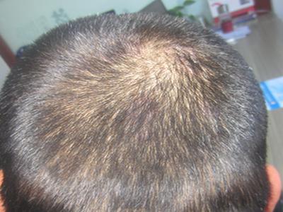 后脑勺的牛皮癣该怎么治疗