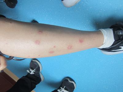 男性手上的牛皮癣怎么会扩散