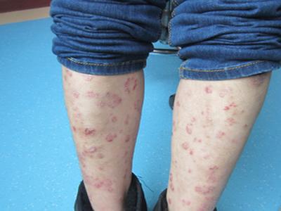 患有牛皮癣的女性在穿衣时应该注意些什么呢