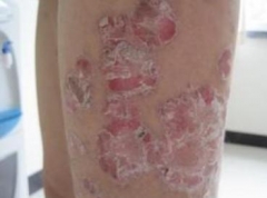 牛皮癣有遗传吗